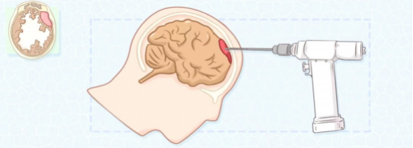 一次性快速錐顱鉆（電動(dòng)鉆夾專(zhuān)用）(圖1)